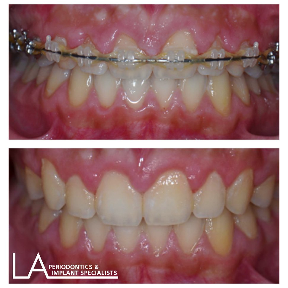 LA Periodontics patient before and after case 02, showing periodontal treatment result