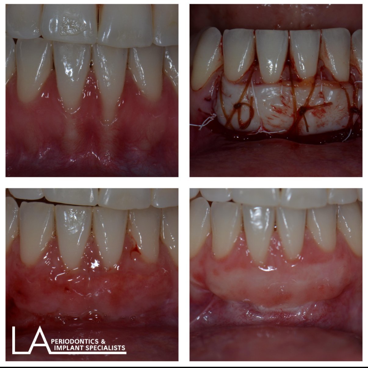 LA Periodontics patient before and after case 05, showing periodontal treatment result