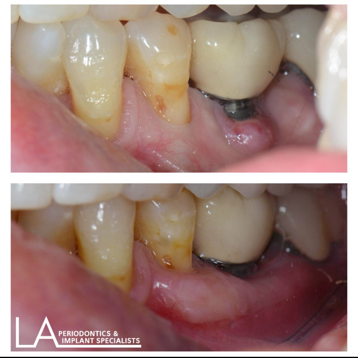 LA Periodontics patient before and after case 07, showing periodontal treatment result