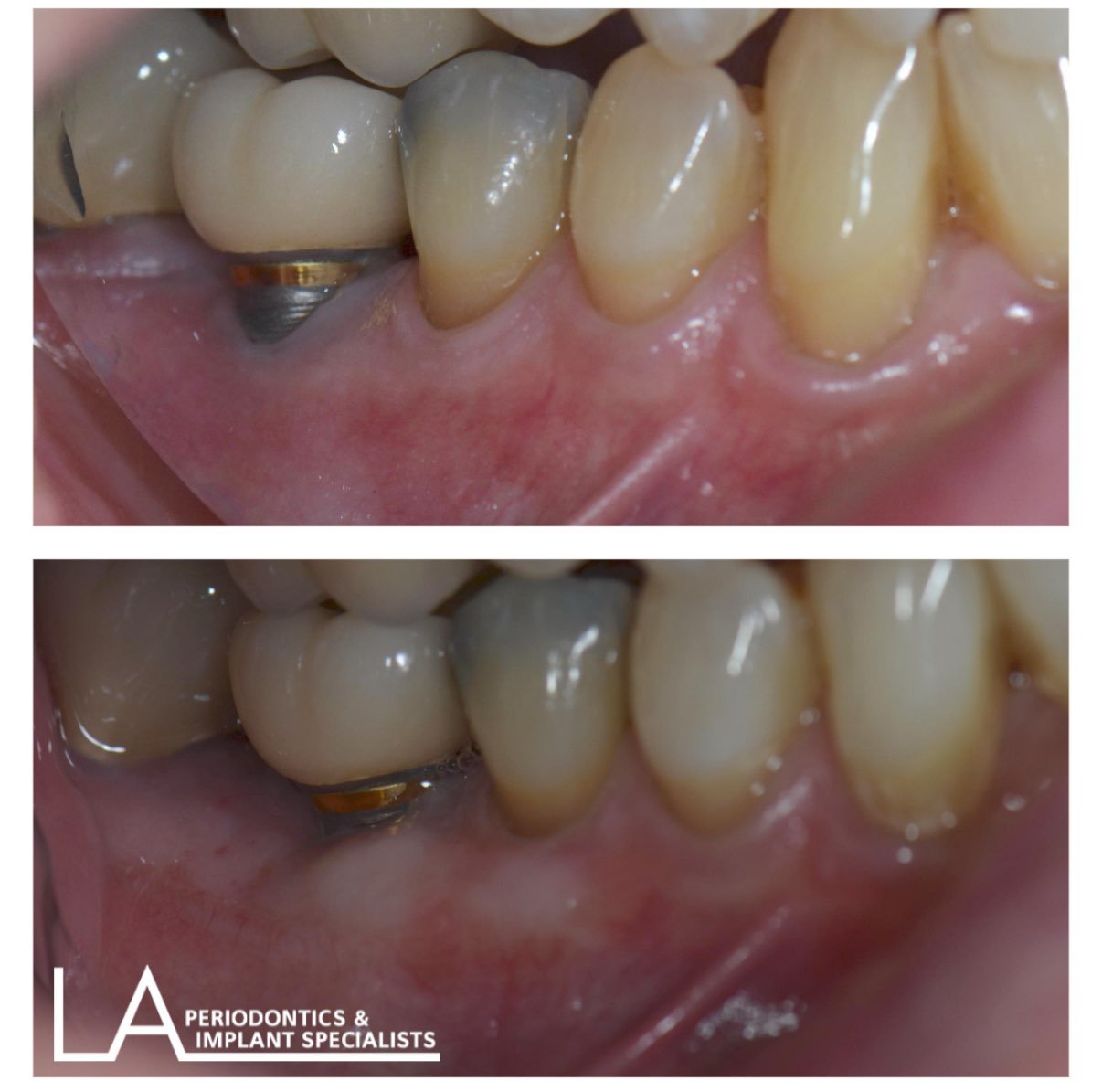 LA Periodontics patient before and after case 09, showing periodontal treatment result