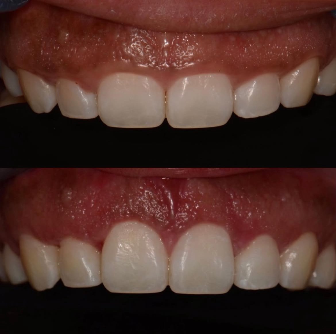 LA Periodontics patient before and after case 10, showing periodontal treatment result