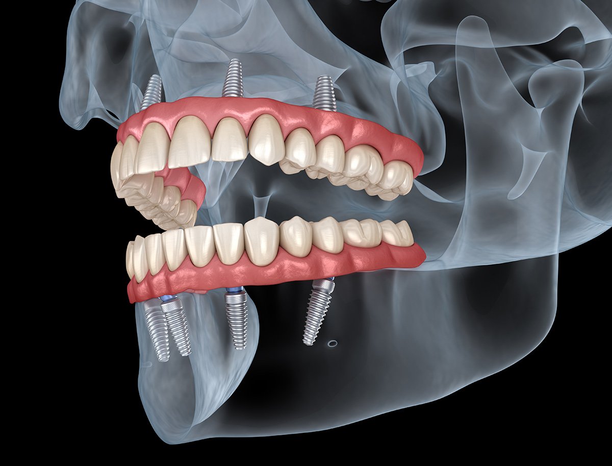 Diagram of four dental implants supporting a full arch fixed bridge