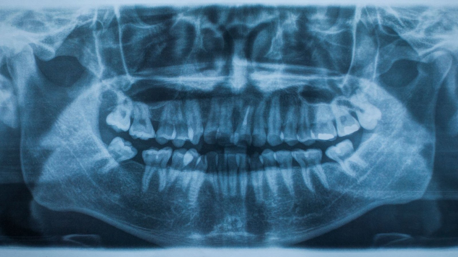 Dental Bone Graft Los Angeles