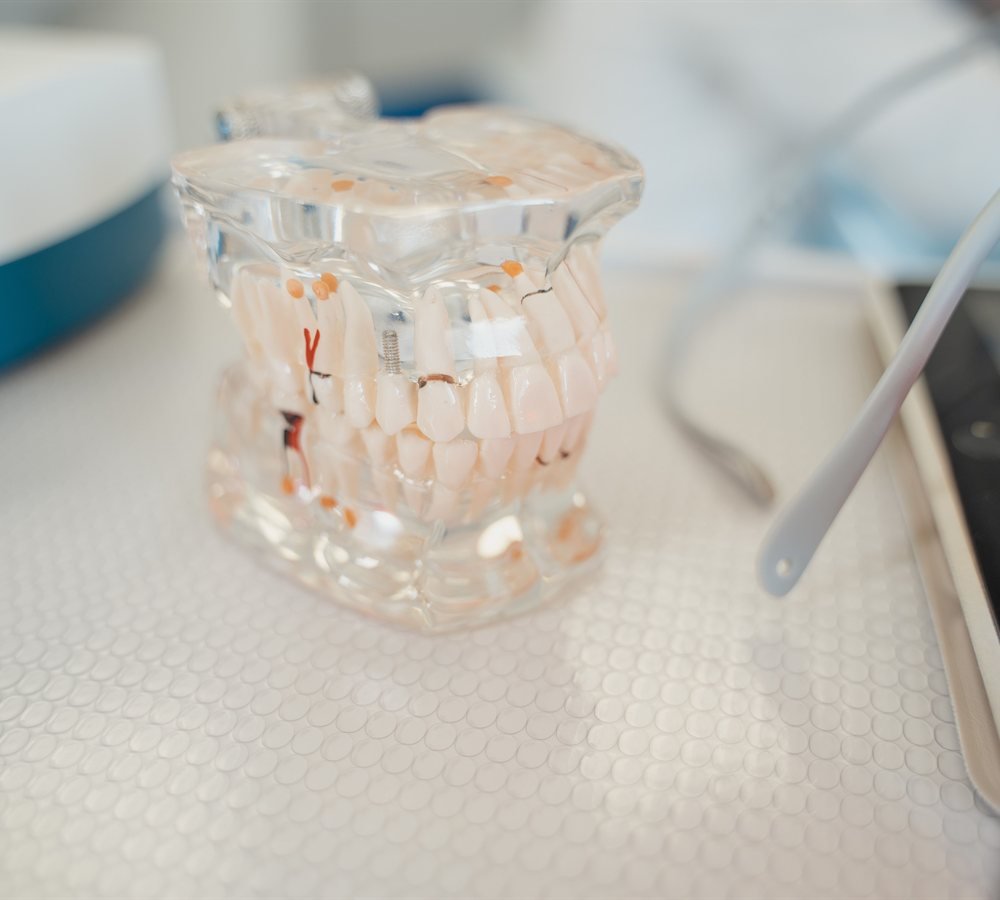 Close-up of a healthy tooth prepared for crown placement after crown lengthening