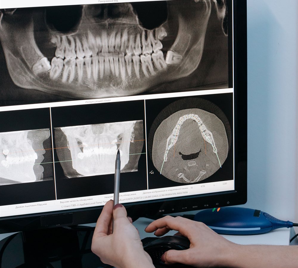 Close-up of a periodontist examining a dental X-ray showing jawbone density