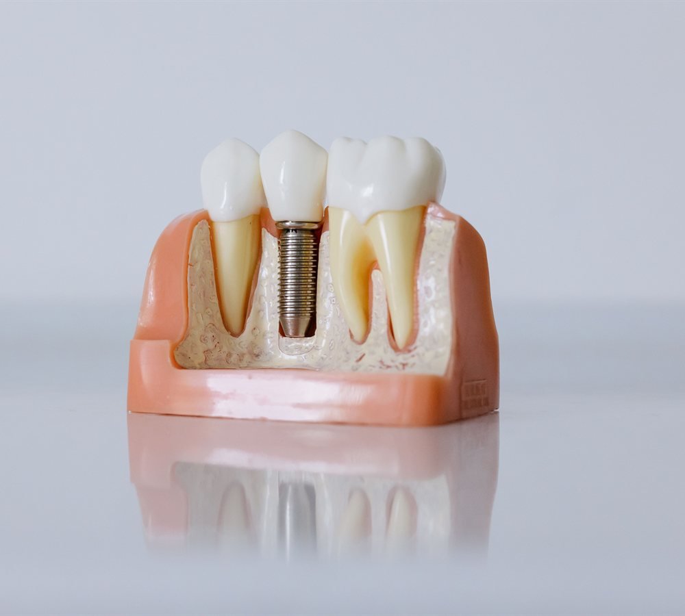 Close up of a dental implant crown and abutment model used during patient consultation