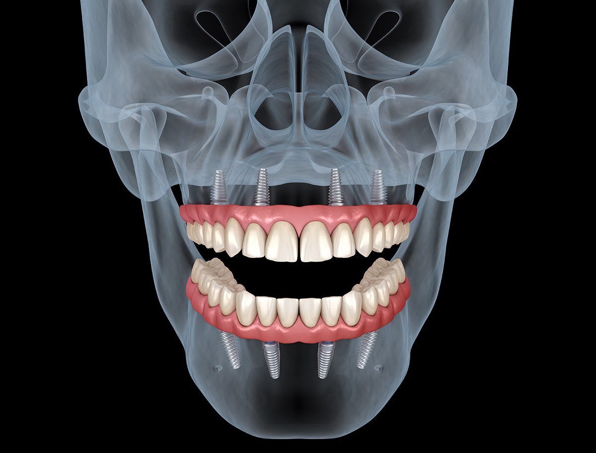 Periodontist examining a dental implant model with a patient in Los Angeles office