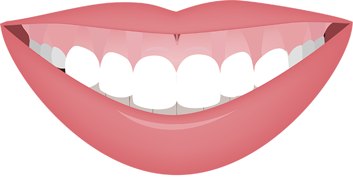 Patient with a balanced, proportional smile after cosmetic gum recontouring in Los Angeles