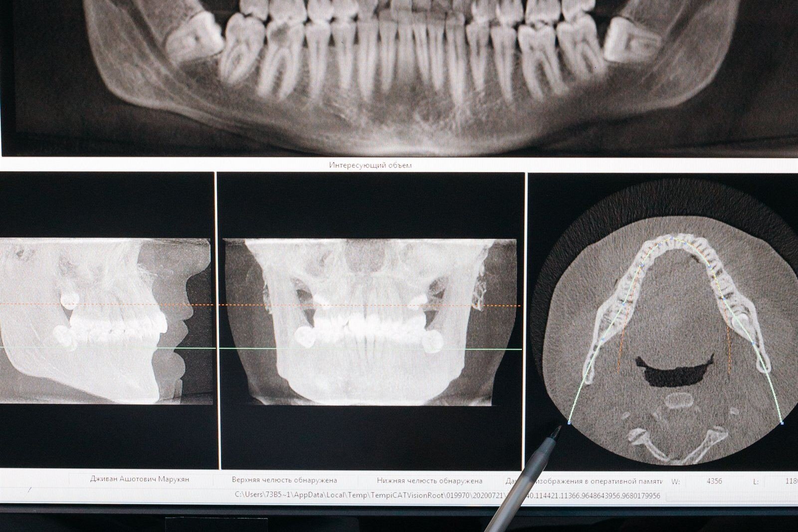 Periodontist reviewing bone regeneration imaging in Los Angeles