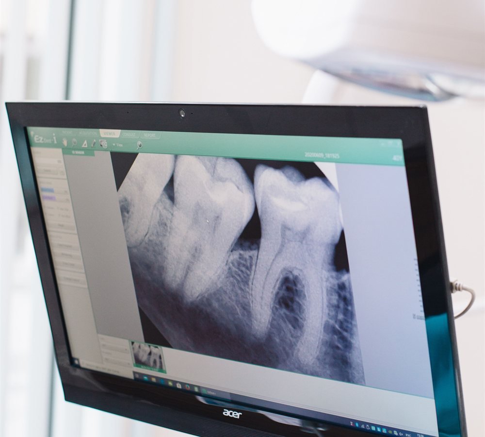 Digital scan showing bone regrowth after periodontal regeneration treatment