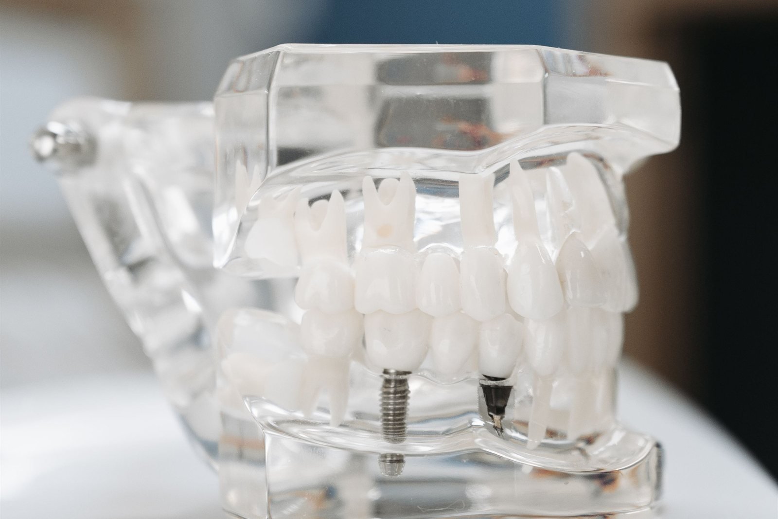 Dental implant model showing a single tooth replacement in the lower jaw