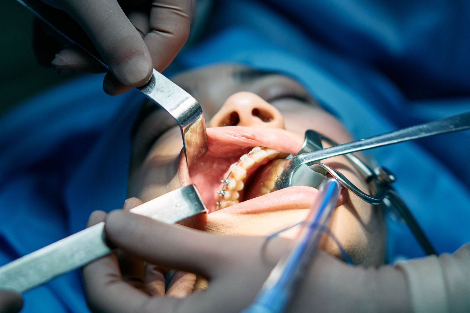 Periodontist performing a minimally invasive pinhole gum graft technique in Los Angeles