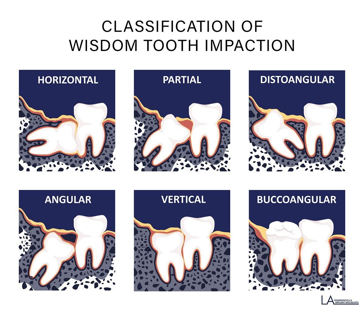 Periodontist examining a patient's mouth before a surgical tooth extraction in Los Angeles